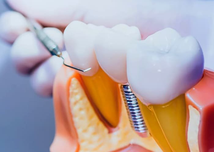 How Long Does A Dental Implant Procedure Take?